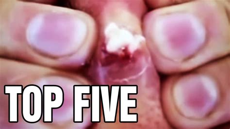 Get Your Skin Fix with the Ultimate Pimple Popping Videos on YouTube