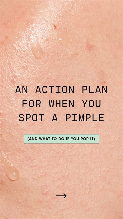 Pimple Popping for Beginners A Step-by-Step Guide