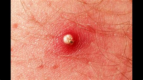 Pimple Tsunami Exploding Zit Unleashes a Torrent of Pus