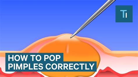 Pimples Pop