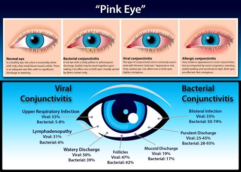 Pink Eye Symptoms