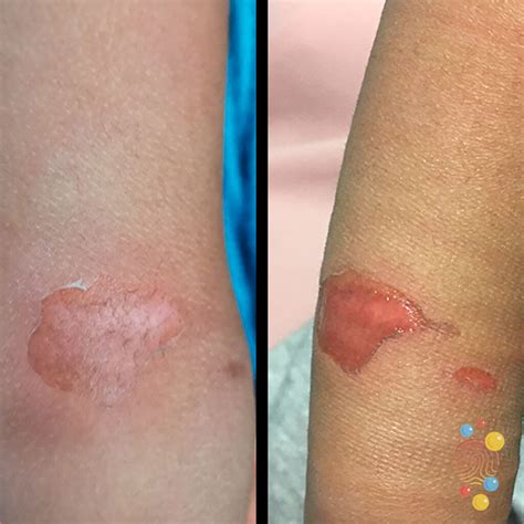 How to Restore Your Skin's Natural Glow: Say Goodbye to Pink Skin After Burn with These Simple Tricks