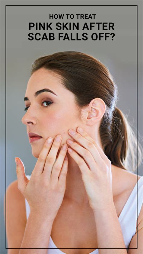 The Blushing Effect: Understanding the Pink Hue of Skin After Cold Sore Scab