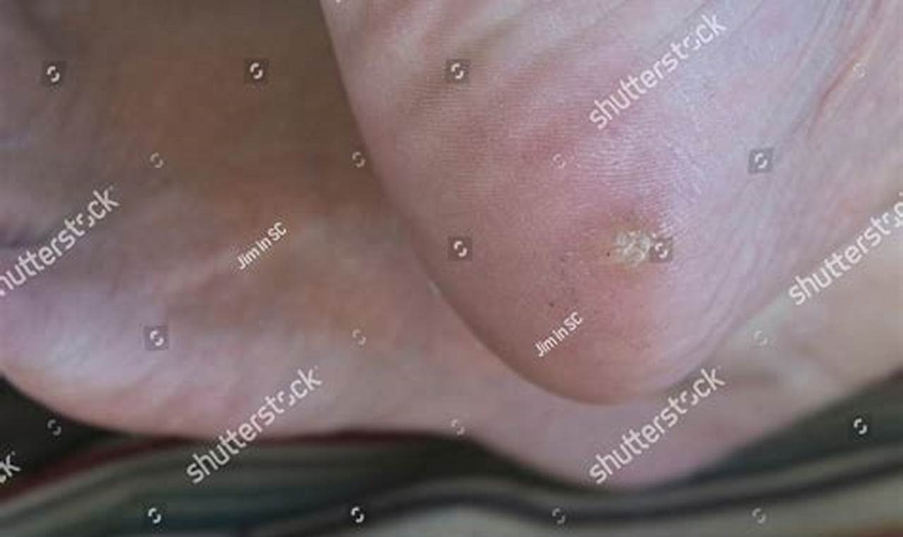 Plantar Wart On Heel