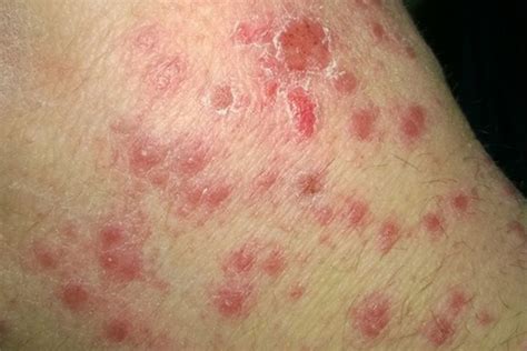 Plaque Psoriasis on Arms: Examples and Symptoms