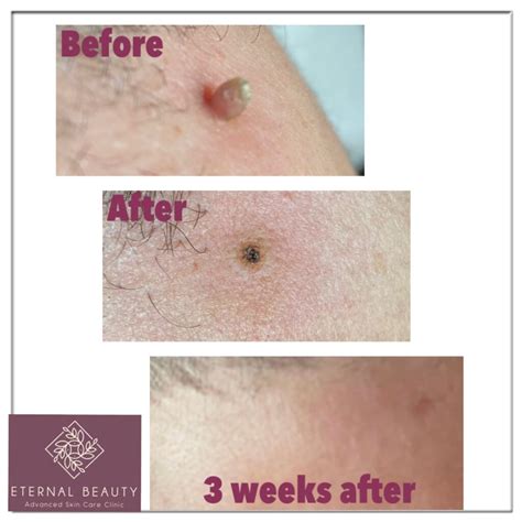 Revitalize Your Skin with Plasma Pen: The Ultimate Solution for Effortless Skin Tag Removal