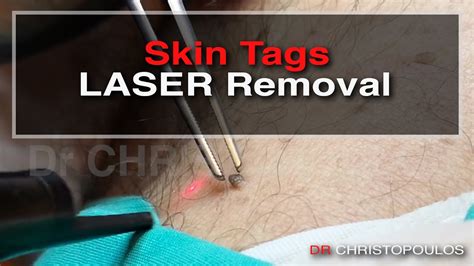 Say Goodbye to Skin Tags with Expert Plastic Surgery Treatment