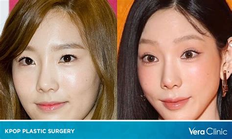 Plastic Surgery Kpop