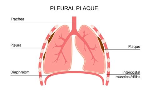 Pleural Plaques: A Common Indicator