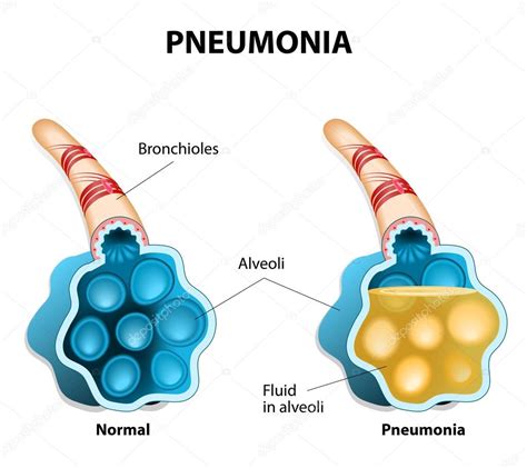 Alveoli