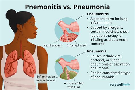 Pneumonitis vs Pneumonia: Understanding the Differences