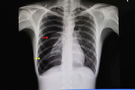 Pneumothorax Clumsy Lost Medical Student That Can’t Find The Bandages