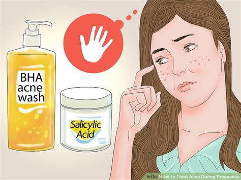 Acne during pregnancy
