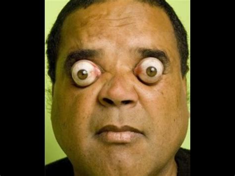 Popped Eyes