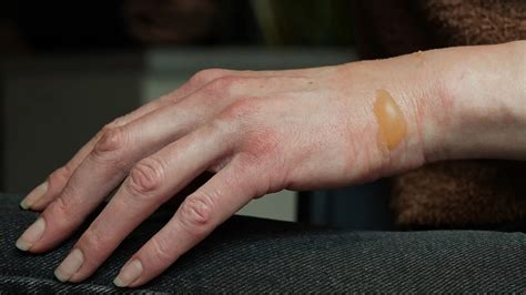 The Fiery Truth About Popper Burns on Skin: Unraveling the Mysteries of These Hazardous Beauty Trends