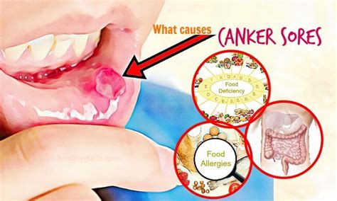 How to Get Rid of a Canker Sore Quickly and Painless - Tips for Popping Canker Sore.