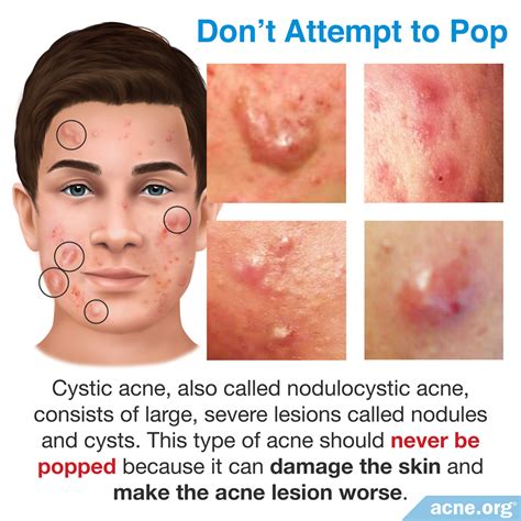 Popping Cystic Acne: The Dos and Don'ts for Clearer, Healthier Skin