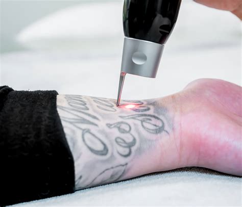 Laser Tattoo Removal Portland Oregon Cascade Tattoo