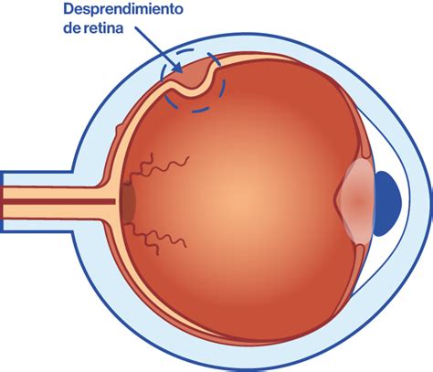Post Operatorio Desprendimiento de Retina | PDF | Ojo humano
