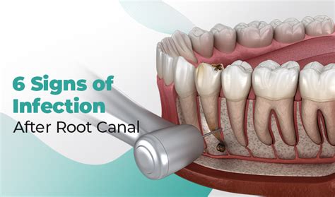 Post Root Canal Infections