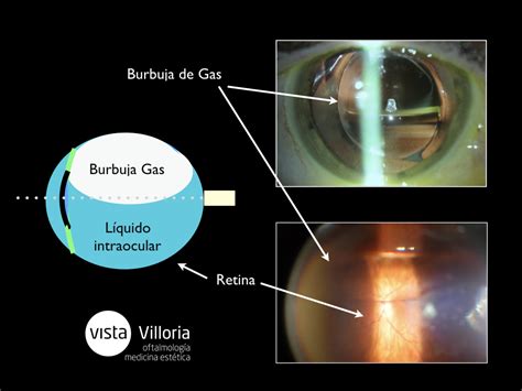 Desprendimiento de retina | Clinica Veravisión