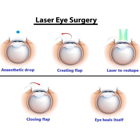Precision LASIK and Refractive Surgery