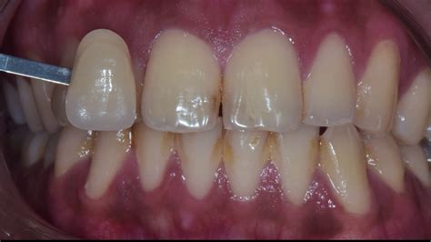 Preparation and Application: Getting the Shade Right