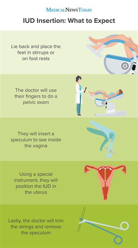 Preparation and Consultation: Getting Ready for Your IUD