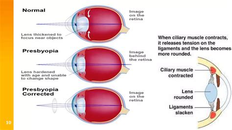 Presbyopia and Accommodation Issues