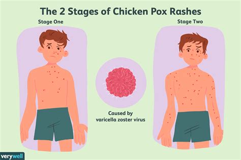 Preventing Chickenpox and Shingles
