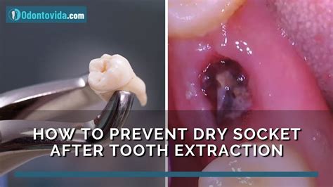 Preventing Dry Socket Tips for a Smooth Recovery