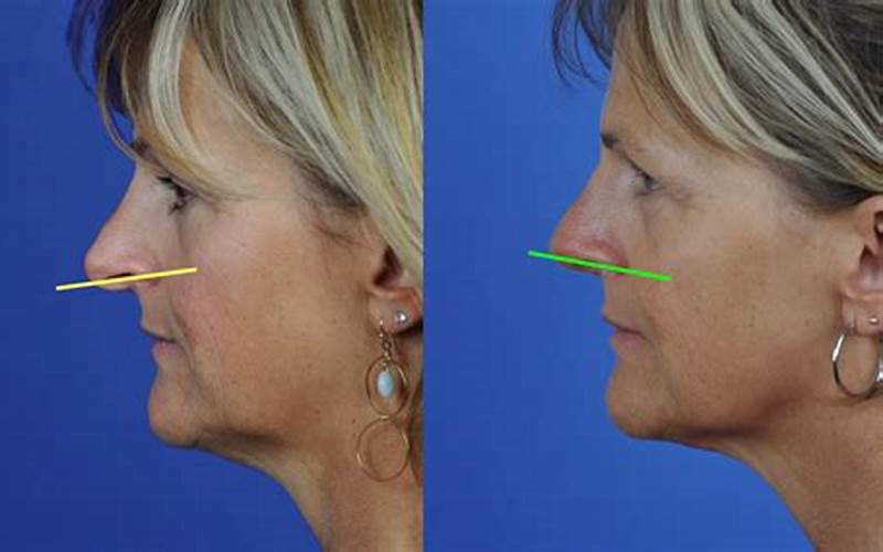 Prevention Of Droopy Nose Tip
