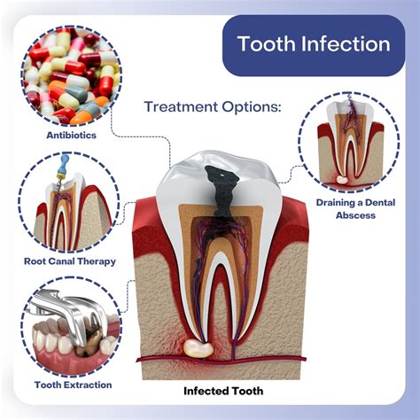 Primary Treatment Options for an Infected Tooth