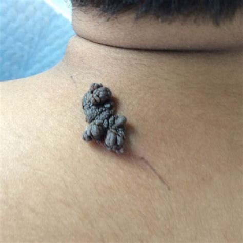 Professional Assessment and Removal Options