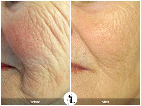 Discover the Wonders of Profound Skin Tightening Near You: Firm, Tone and Revitalize Your Skin Today!