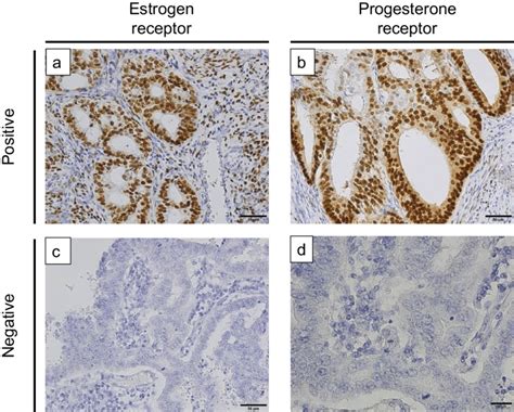 Progesterone Receptor IHC Test and interpretation