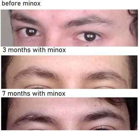 Progress Timeline for Minoxidil Eyebrows