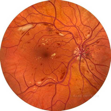 Proliferative Retinopathy (PDR)