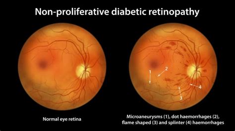 Proliferative vs. Non-Proliferative Retinopathy