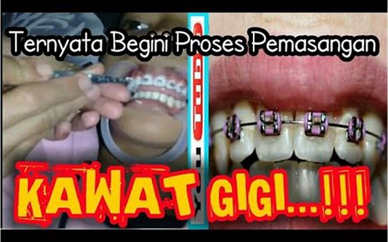 Proses Pemasangan Kawat Gigi