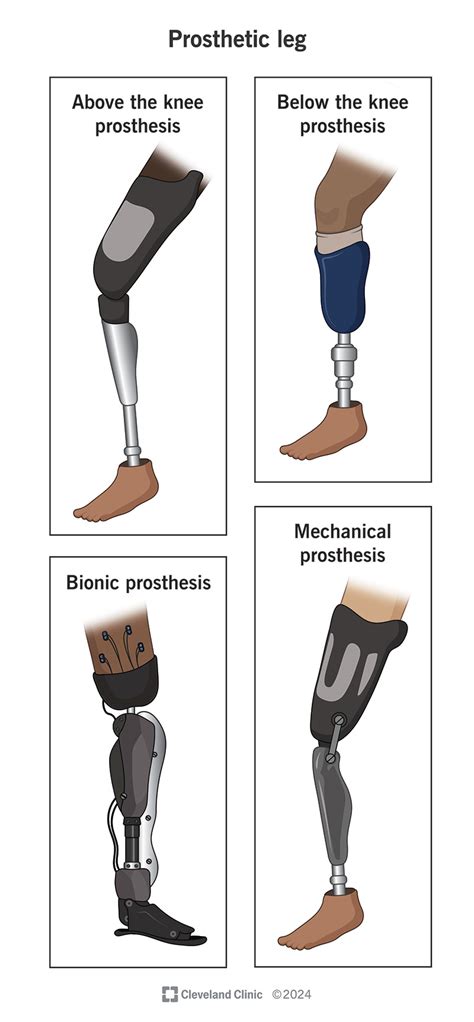 Prosthetic Legs: Installation & Care – Simplified.