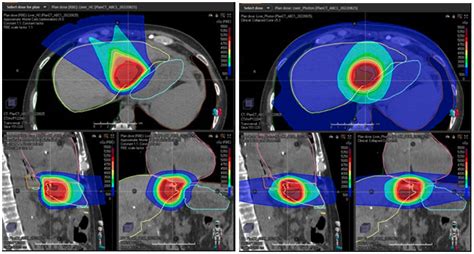 Proton Therapy for Liver Cancer