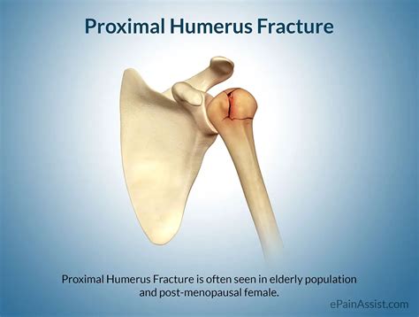 Proximal Humerus Fracture Core EM