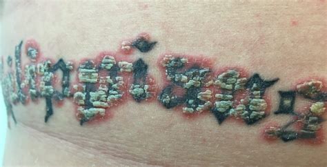 PSORIASIS AND TATTOOS EVERYTHING YOU NEED TO KNOW