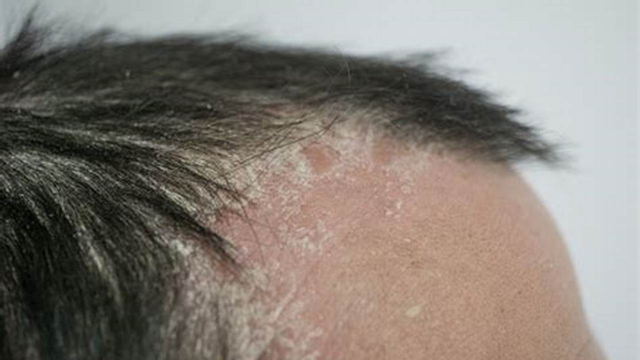 Psoriasis, Penyakit Rambut