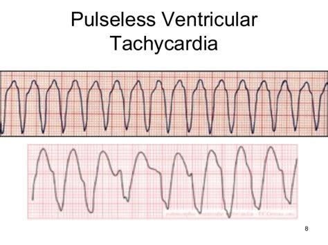 Pulseless