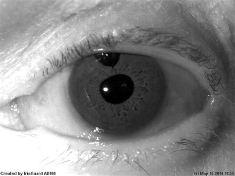 Pupil Distortion and Irregularity