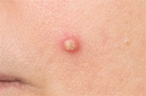 Pus: Penyebab & Pengobatan Efektif