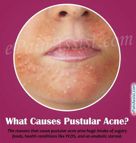 Pustular Acne: Causes & Effective Treatments