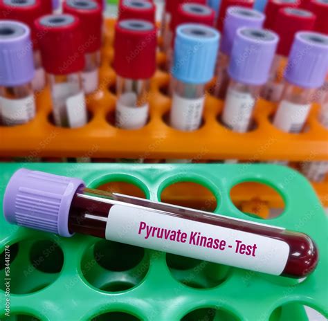 Pyruvate Kinase Test and interpretation
